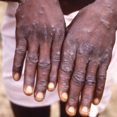 Cinco preguntas clave sobre la viruela del mono que ya registra casos en 15 países